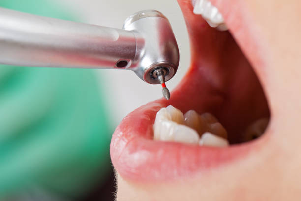 Best Emergency Tooth Extraction in Williston, FL